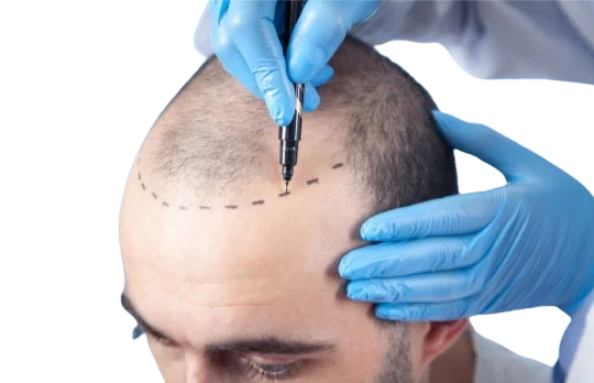 HAIR-TRANSPLANT.jpg-removebg-preview