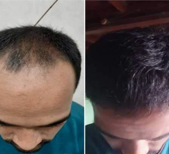 Hair Transplant