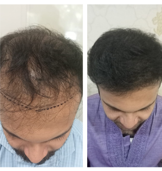 Hair Transplant